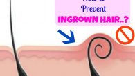 How to Prevent Ingrown Hair