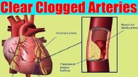 Foods to Prevent Clogged Arteries