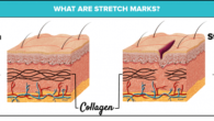 what-are-stretch-marks