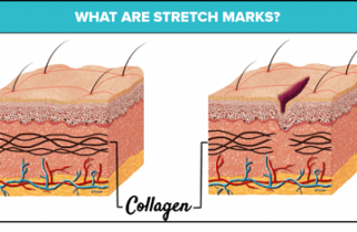 what-are-stretch-marks