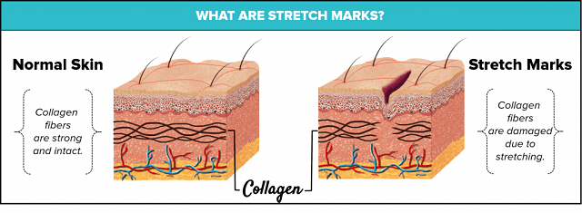 what-are-stretch-marks